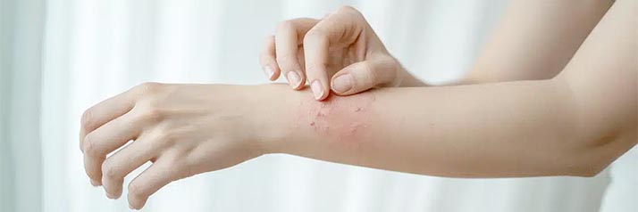 Allergies et intolérances